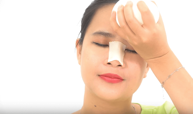 Apply a cold compress after rhinoplasty to reduce swelling and bruising.