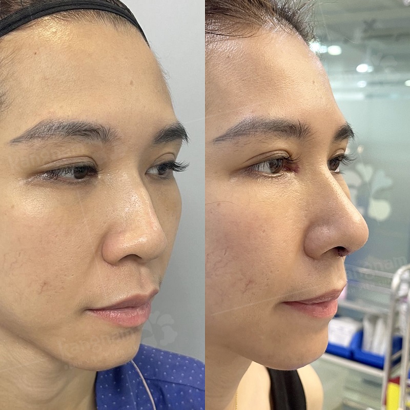 The results of rhinoplasty are long-lasting.