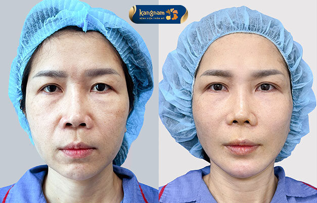 A client with mild wrinkles underwent a thread lift; after the procedure, the skin appears smoother and significantly more youthful.