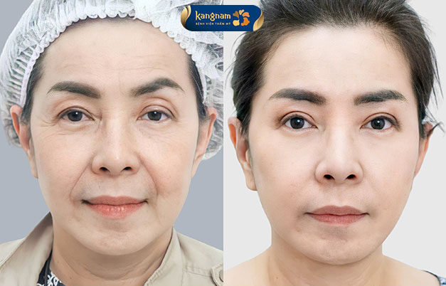 Before-and-after images of a client following a full facelift, showing a significant improvement in multiple wrinkles.