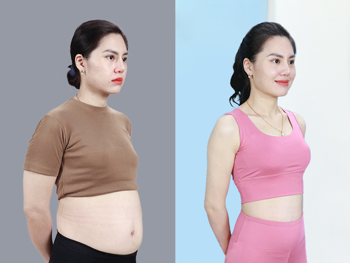 Before and after results of abdominal liposuction, showing a significantly slimmer waistline.