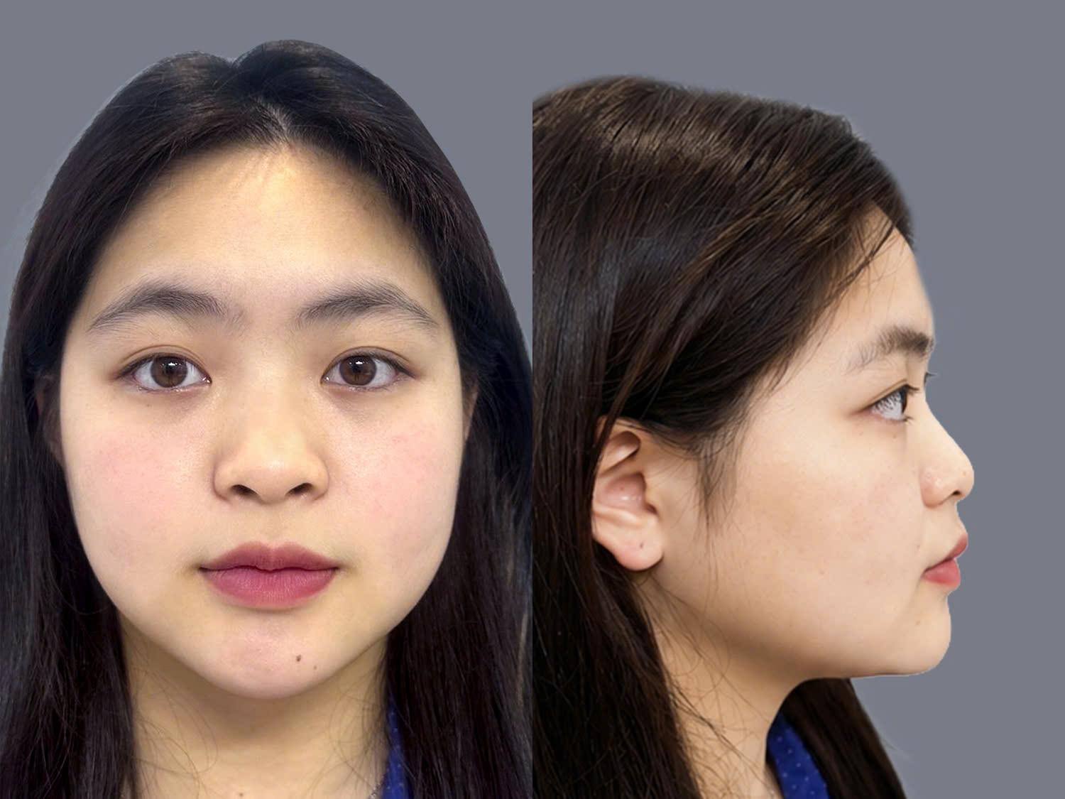 Angeliaca nguyễn trước khi nâng mũi, mũi thấp tẹt khiến gương mặt thiếu điểm nhấn