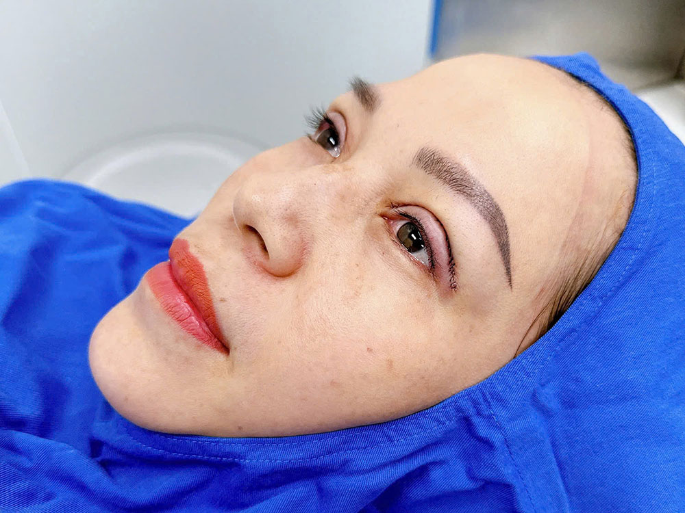 Ca cắt mí khoảng 60 phút, bác sĩ điều chỉnh lại đường nếp mí để hai bên mắt hài hòa hơn