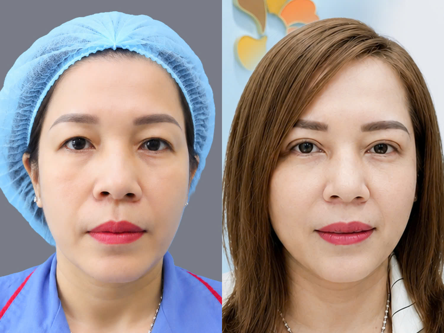 Anna trước và sau khi cắt mí, gương mặt sắc nét, có điểm nhấn