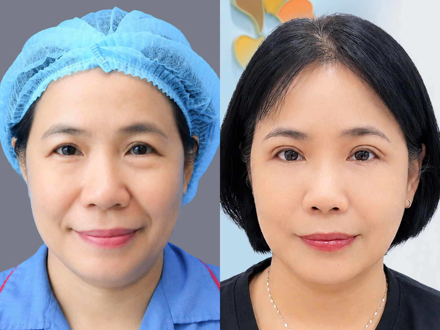 ảnh trước và sau khi cắt mí của chị Pauline Phạm , gương mặt trẻ hơn,mí đều và cân đối