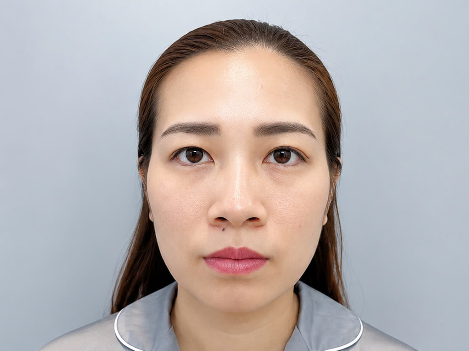 Hương Lưu – Việt kiều Thụy Điển bị sụp mú, mũi thấp và cánh mũi to bè
