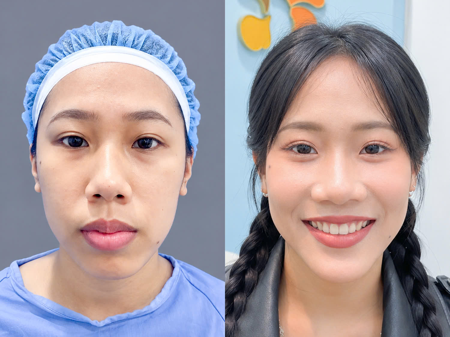 ảnh trước và sau khi chỉnh hàm hô để thấy rõ sự thay đổi