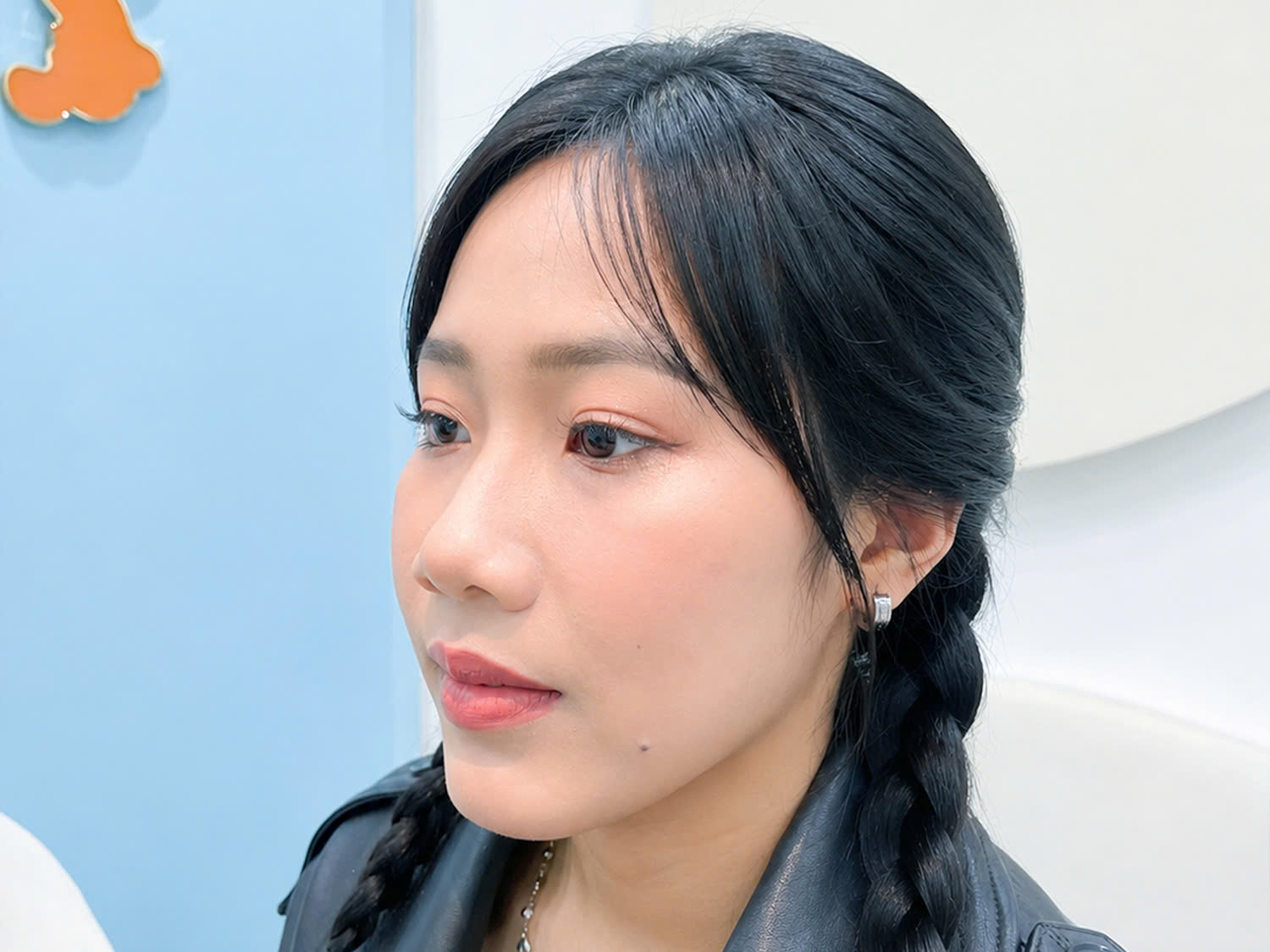 Như Quỳnh sau khi chỉnh hàm hô, khuôn miệng cân đối, gương mặt trẻ hơn