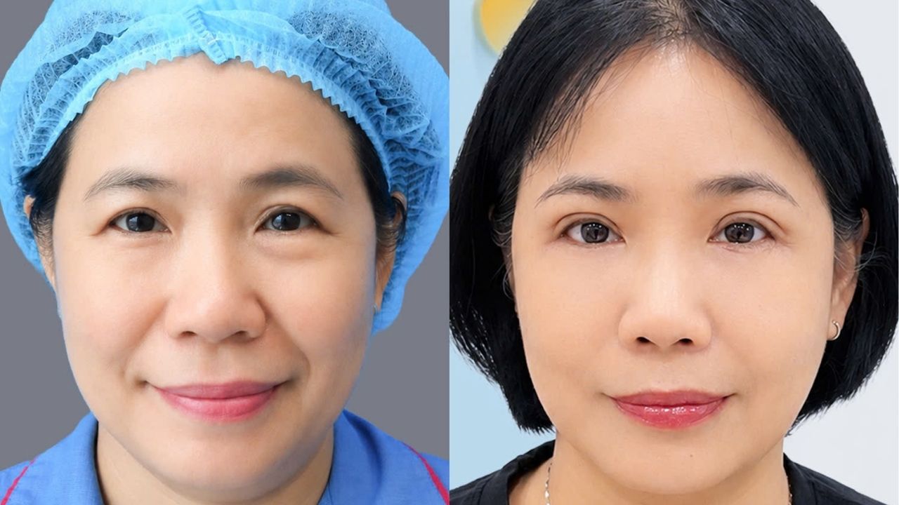 Pauline lấy lại đôi mắt tươi tỉnh sau cắt mí trên và dưới tại Kangnam