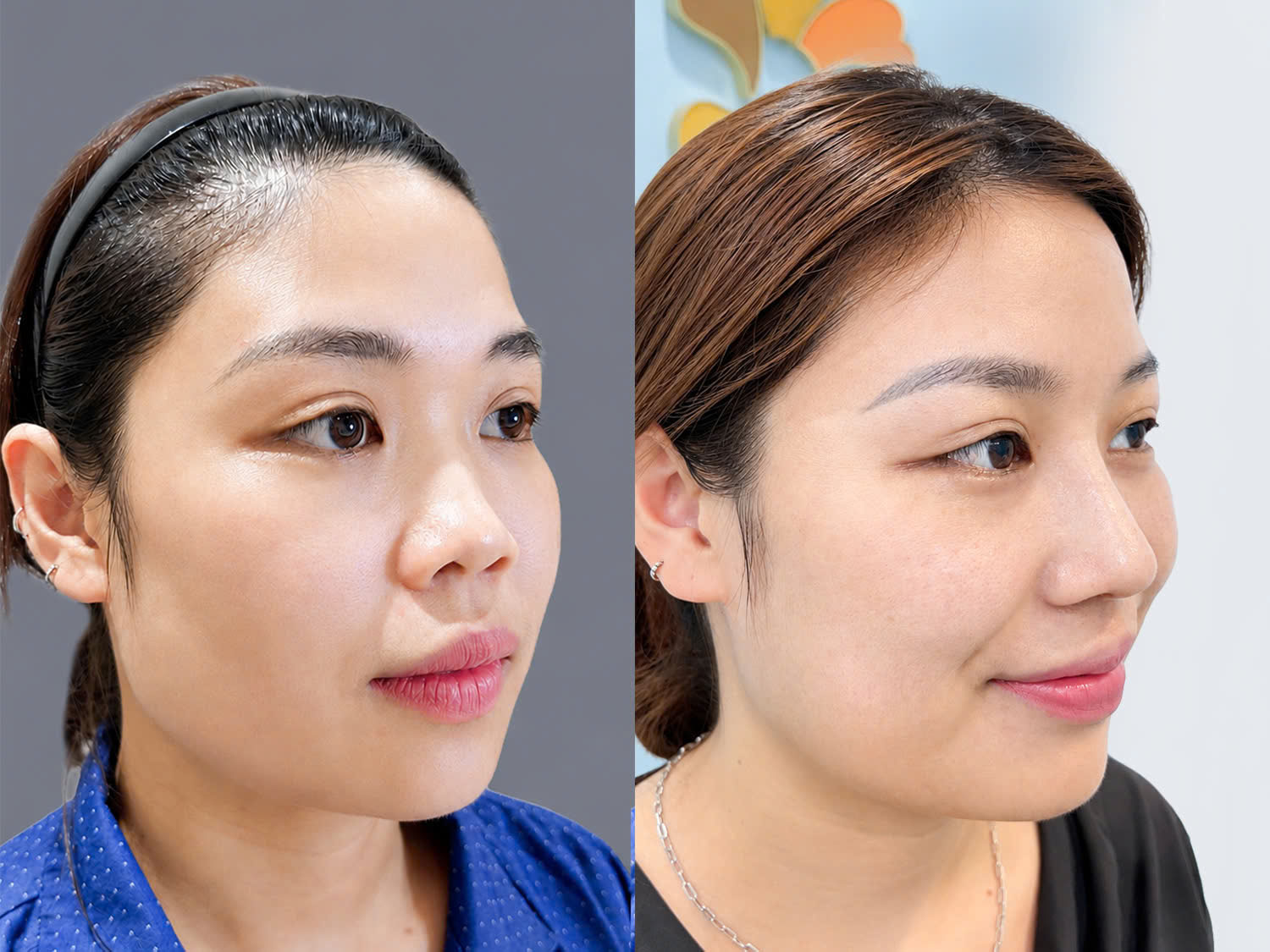 ảnh trước và sau khi nâng mũi của Phương Nguyễn, gương mặt sau nâng mũi có điểm nhấn, góc nghiêng đẹp và sắc nét