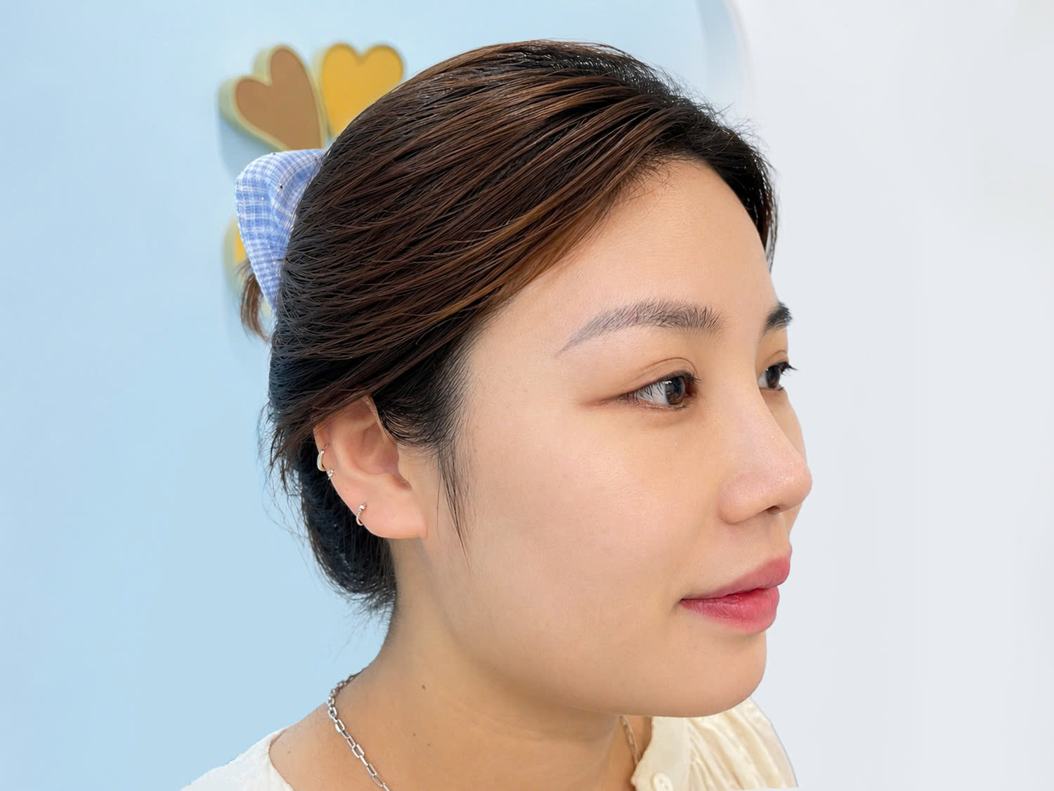 Phương Nguyễn sau khi nâng mũi và tái khám, mũi gom phom ổn định