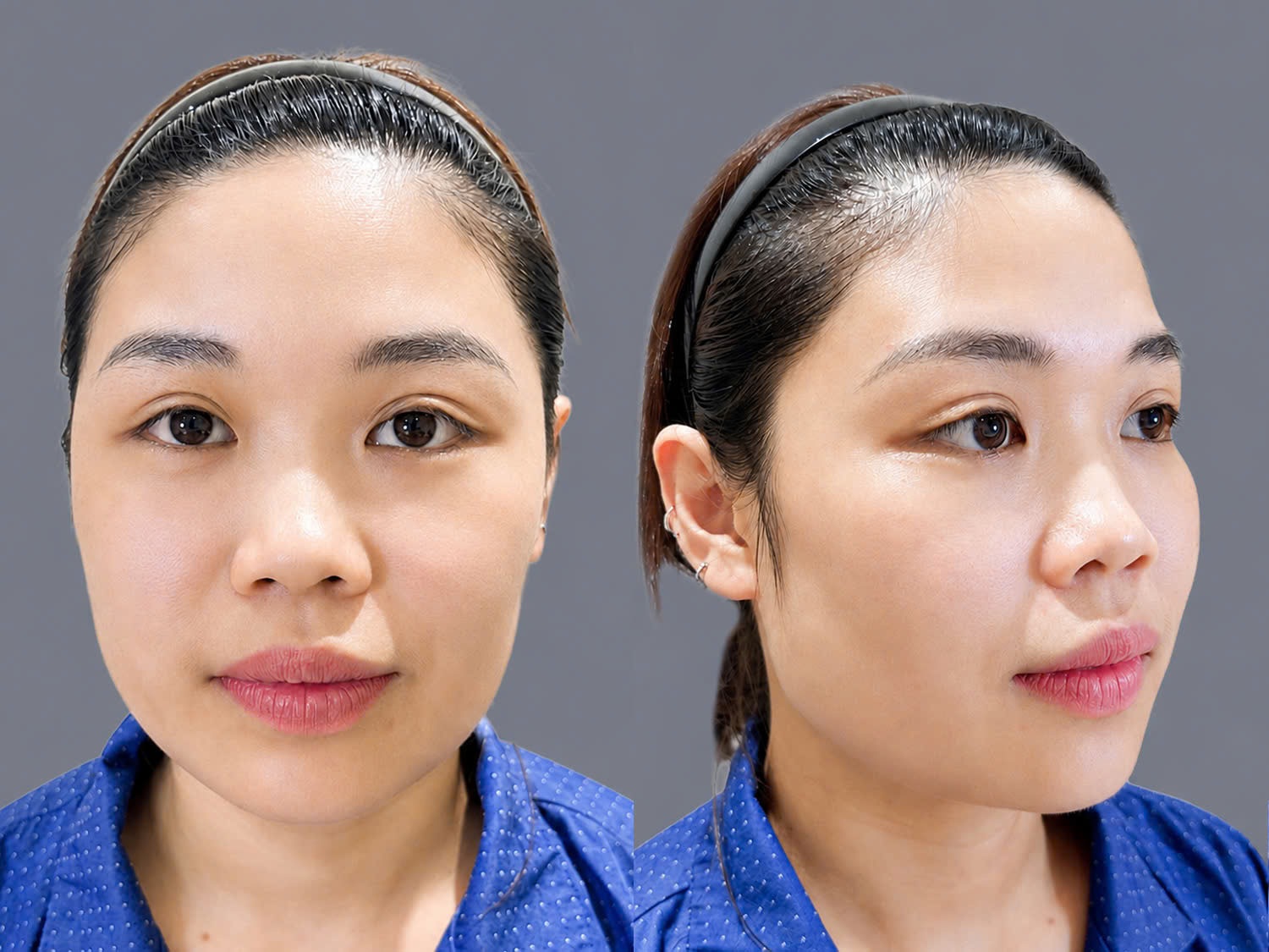 tình trạng mũi thấp tẹt của Phương Nguyễn trước khi phẫu thuật