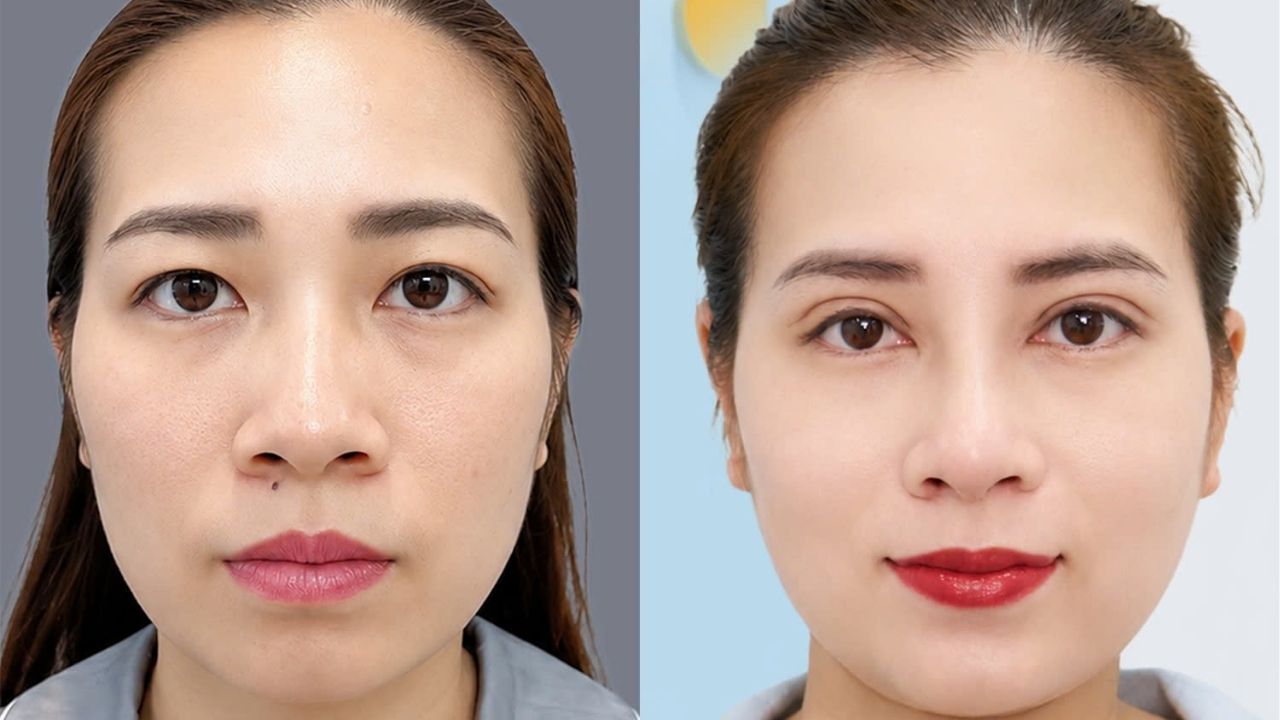 Việt kiều Thụy Điển thay đổi diện mạo sau phác đồ nâng mũi kết hợp cắt mí tại Kangnam