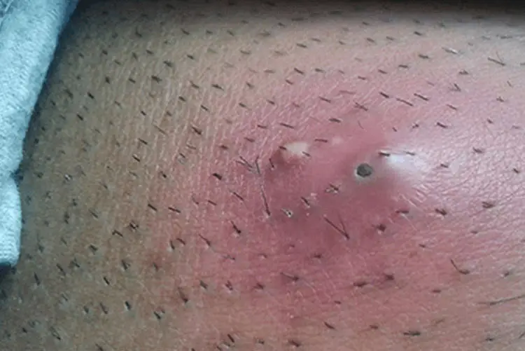 Early hair removal causes folliculitis. 