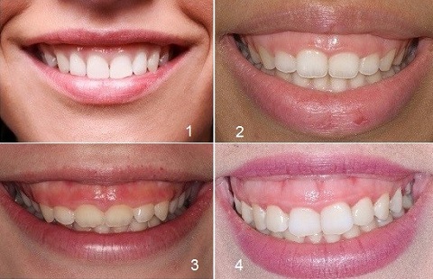 There are 3 common levels of gummy smile severity