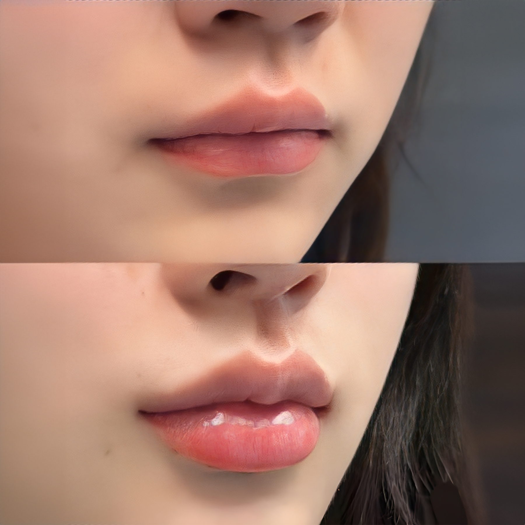 Patients achieve full and plump lips after lip filler injection.