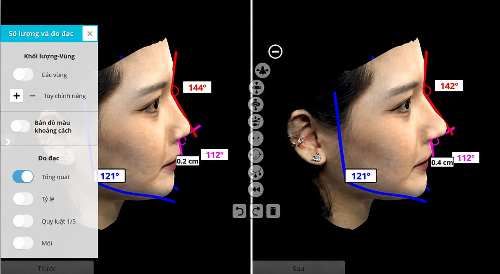 Application of AI technology during the rhinoplasty process
