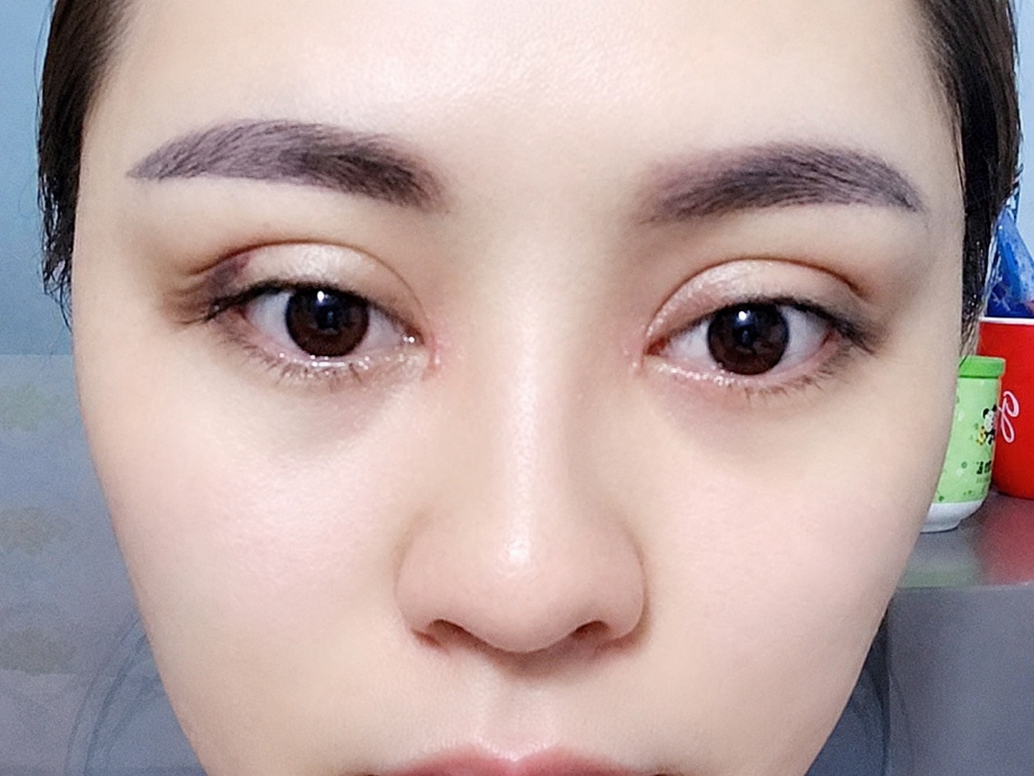 Asymmetrical eyelids affecting overall facial aesthetics