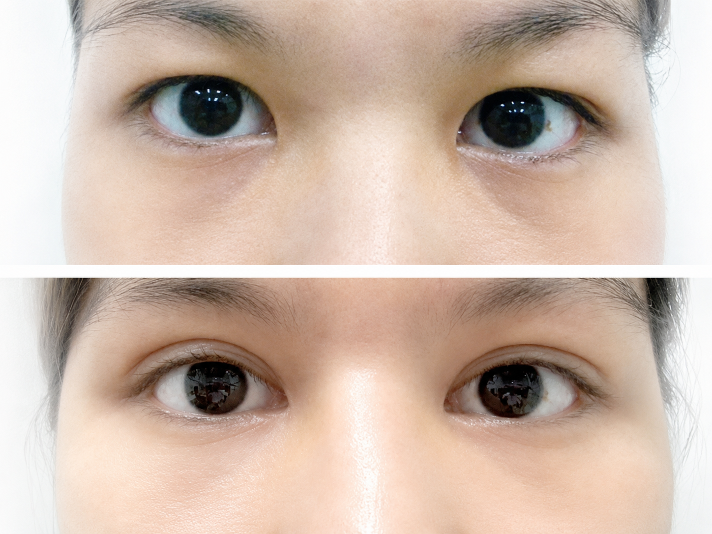 Improperly performed canthoplasty can leave visible scarring
