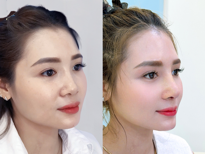 The nose may appear higher, more refined, and more harmonious with the facial features after rhinoplasty at Kangnam.