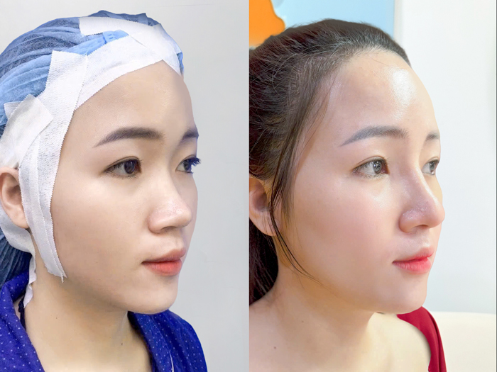 Cartilage-wrapped rhinoplasty is suitable for noses with multiple imperfections.
