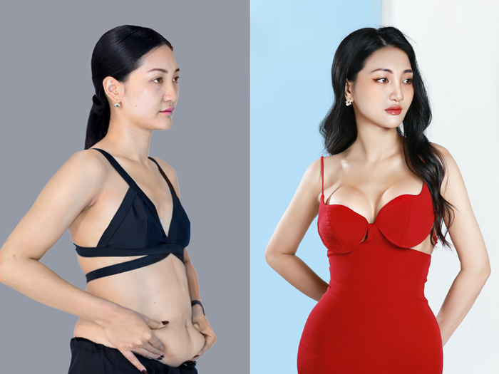 Client Doris Truong after breast augmentation at Kangnam