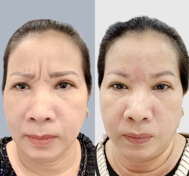 Botox injections can effectively eliminate frown lines.