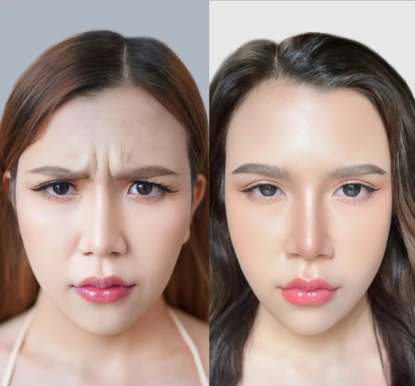 Botox injections to smooth frown lines are painless when using genuine products.