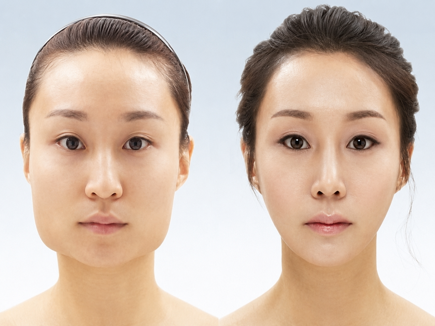 Botox treatment costs in Vietnam are consistently lower