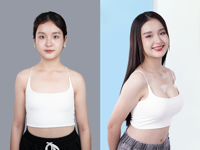 Visible structural improvement after breast augmentation