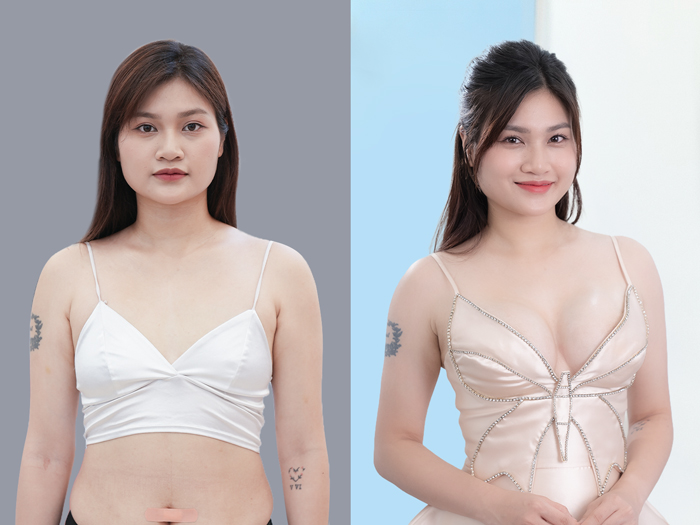 6D Breast Augmentation is painless, rapid in recovery, and yields naturally beautiful results