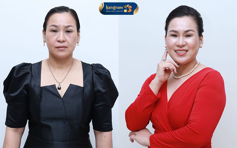 Overseas Vietnamese patients choose Kangnam for facial rejuvenation treatments.