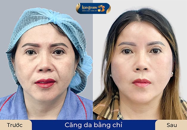 Lấy lại nét xuân, da căng hơn, săn chắc hơn