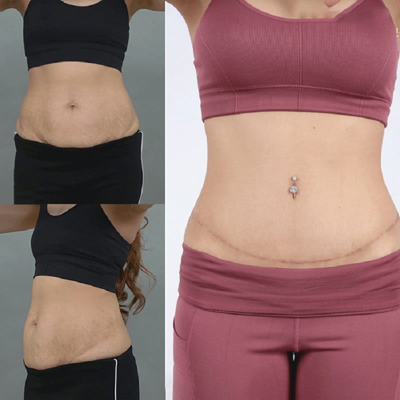 A surgical scar commonly remains beneath the bikini line after abdominoplasty.