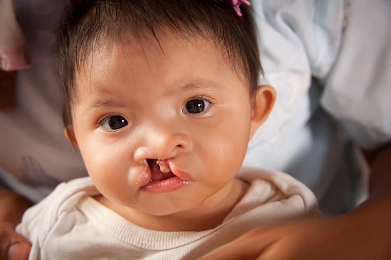 Cleft mouth is frequently accompanied by a cleft lip