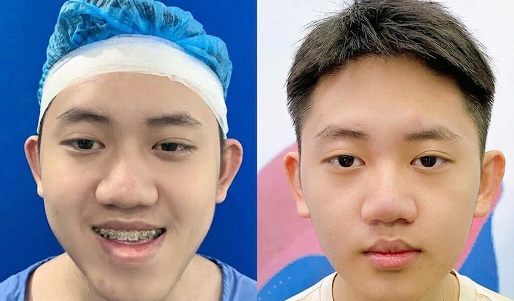 Balanced bite and confident smile thanks to comprehensive maxillofacial intervention