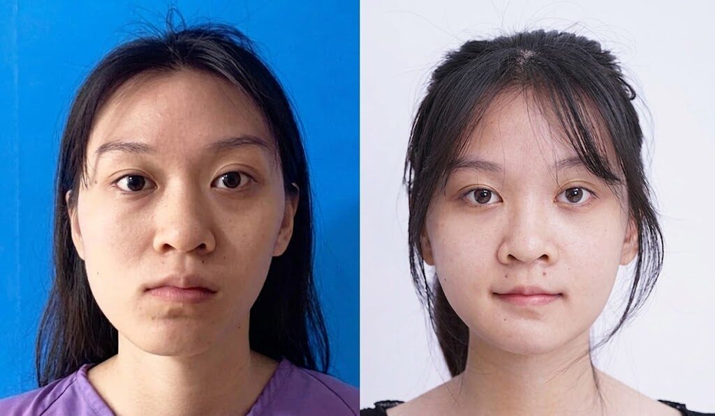 Clients experience remarkable aesthetic and functional transformations after jaw correction