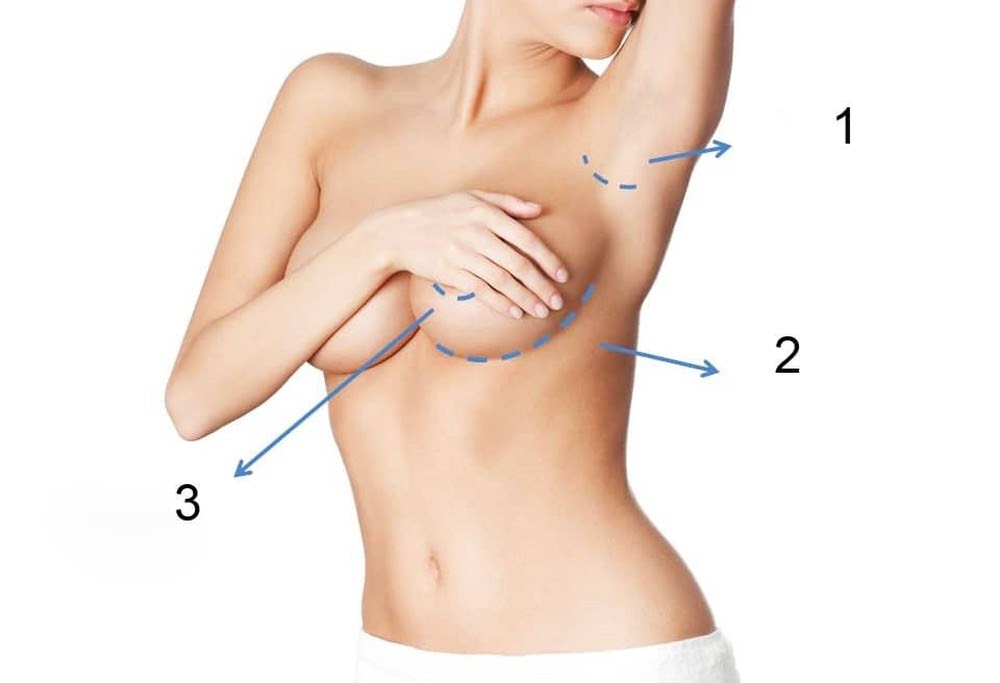 There are 3 basic surgical incision routes used to place breast implants in breast augmentation