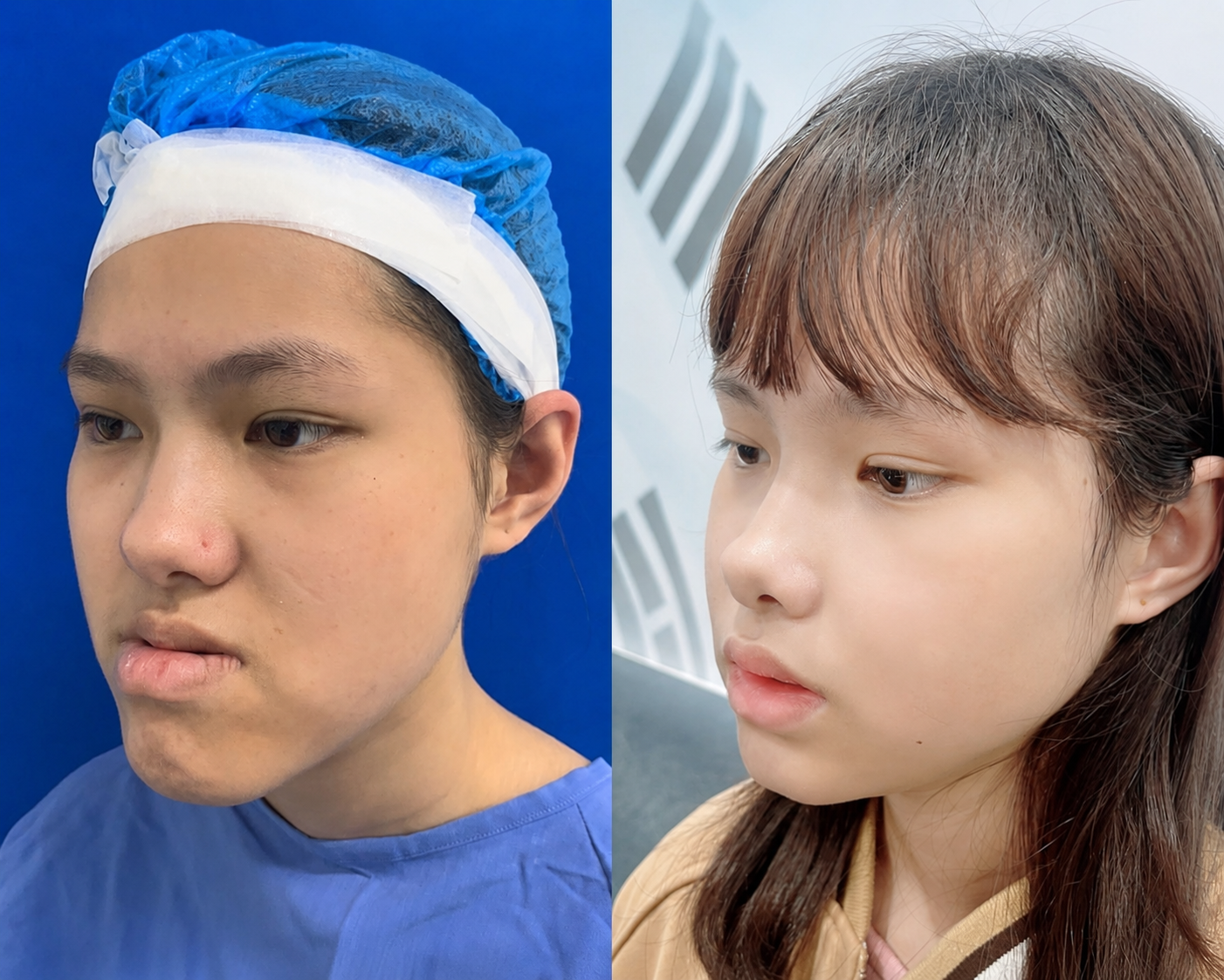 Images after concave face surgery