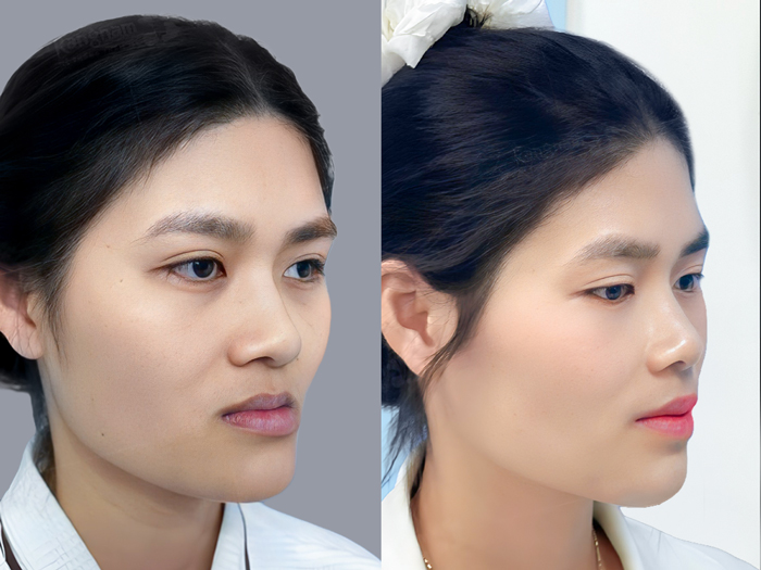 Possessing a pretty and confident smile after underbite jaw correction