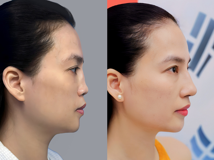 Complex damaged noses should consider autologous rib cartilage rhinoplasty