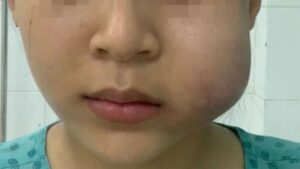 Delayed Swelling After Filler Injections? Causes and 7 Immediate, Effective Solutions