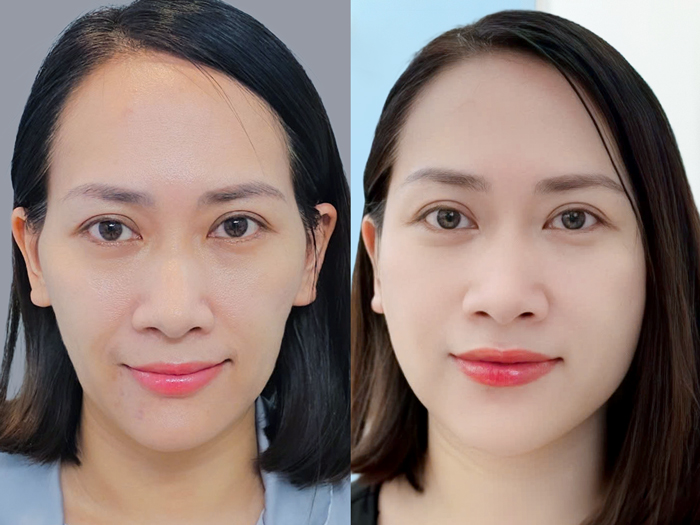Autologous fat grafting for the forehead and temples at Kangnam
