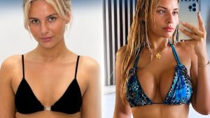 How Long After Breast Augmentation Do Breasts Look Natural?