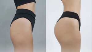 How Long Does Gluteal Fat Grafting Last? Key Points to Consider