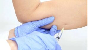 How Much Does Botox for Arm Slimming Cost? Essential Things to Know