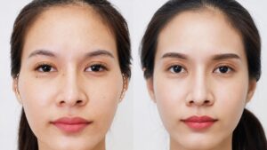 How Much Does Cheekbone Reduction Cost?