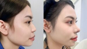 How Much Does Rhinoplasty Cost? Should You Choose Low-Cost Services?