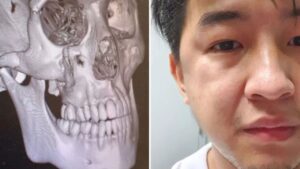 How long does a fractured cheekbone take to heal? An in-depth answer from Kangnam’s specialists