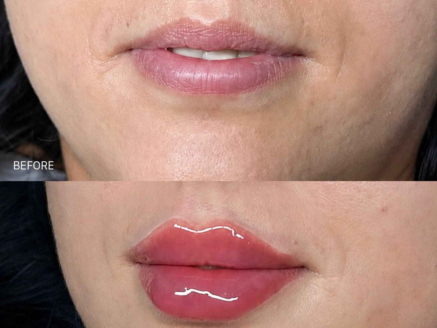 Lips that are full, plump, and alluring after filler injections. 